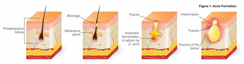 Diagram of acne formation under the skin